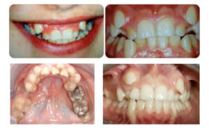 dente del giudizio ed evoluzione, deformità